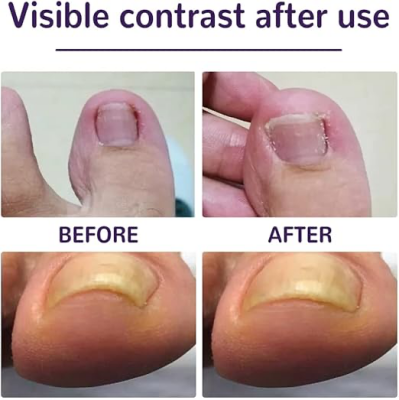 Ayak Tırnağı Düzeltme Bandı 50 Adet (1)